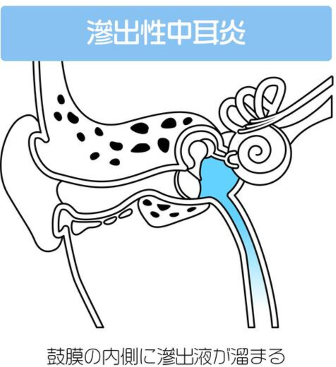 滲出性中耳炎のイメージ（中耳に液体がたまる様子）