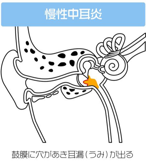 慢性中耳炎のイメージ（鼓膜に穴が残る状態）