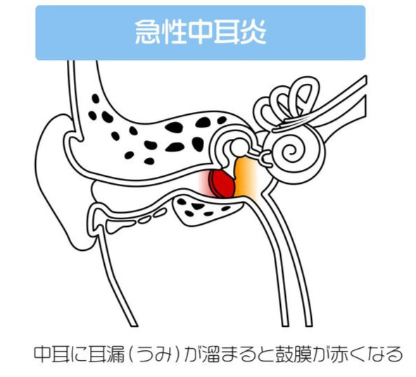 急性中耳炎のイメージ（耳の炎症と膿のたまり方）