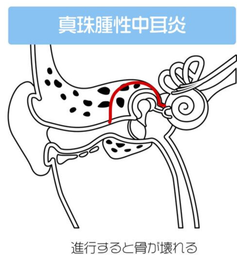 真珠腫性中耳炎│中耳の中に皮膚のかたまり（真珠腫)ができるイメージ