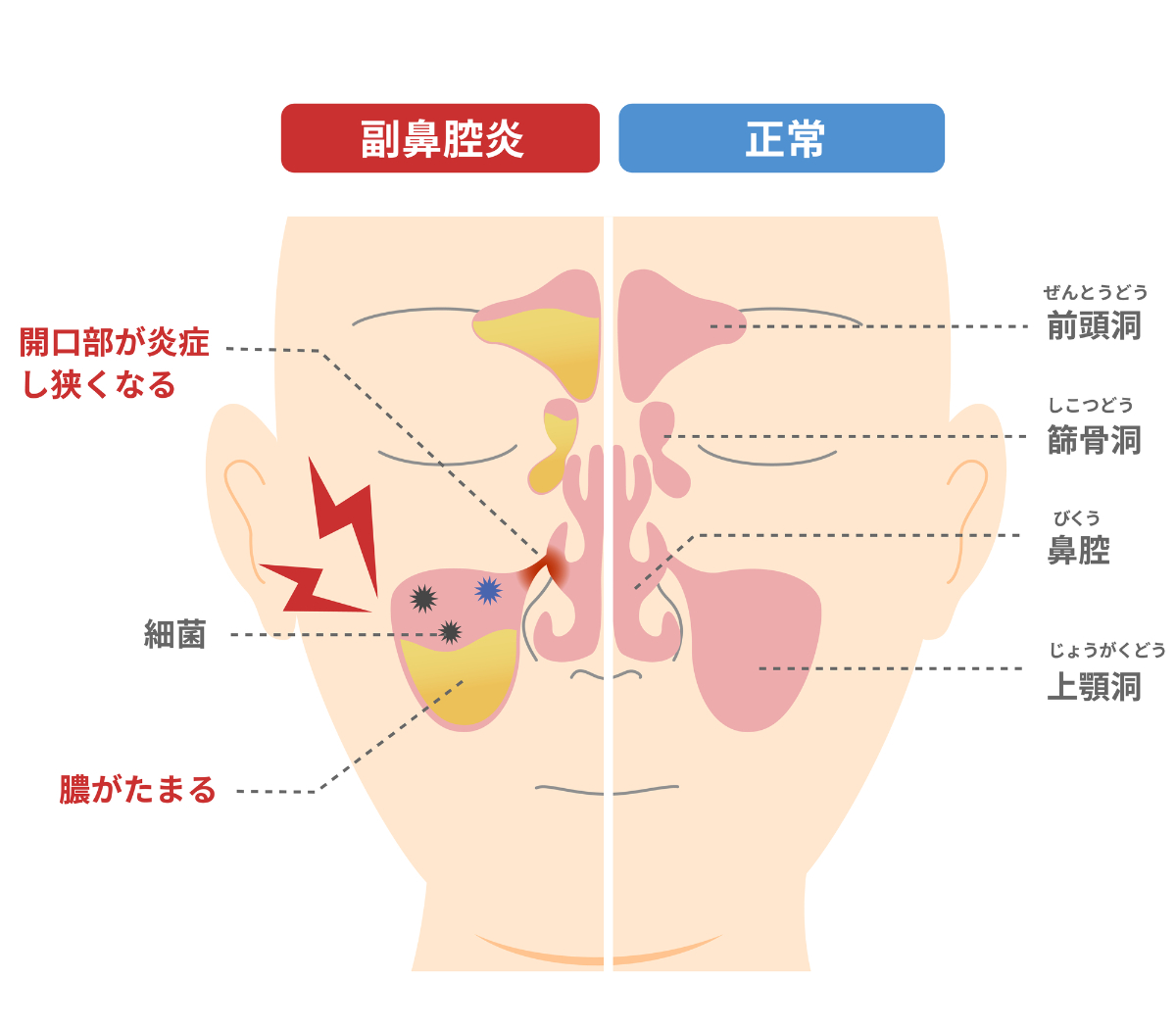 副鼻腔炎と正常な鼻の違いを説明するイメージ写真