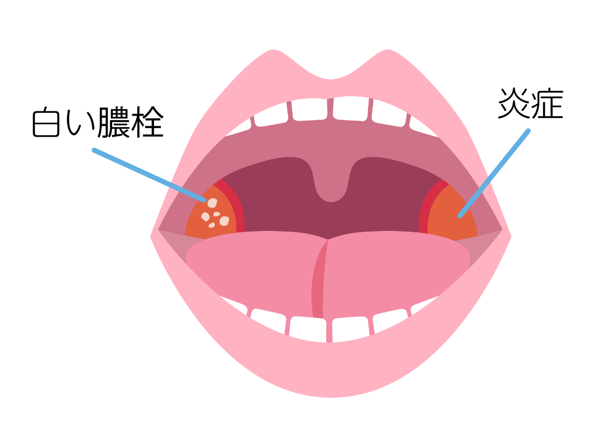 扁桃炎のイメージ│のどの痛み・腫れの原因となる疾患
