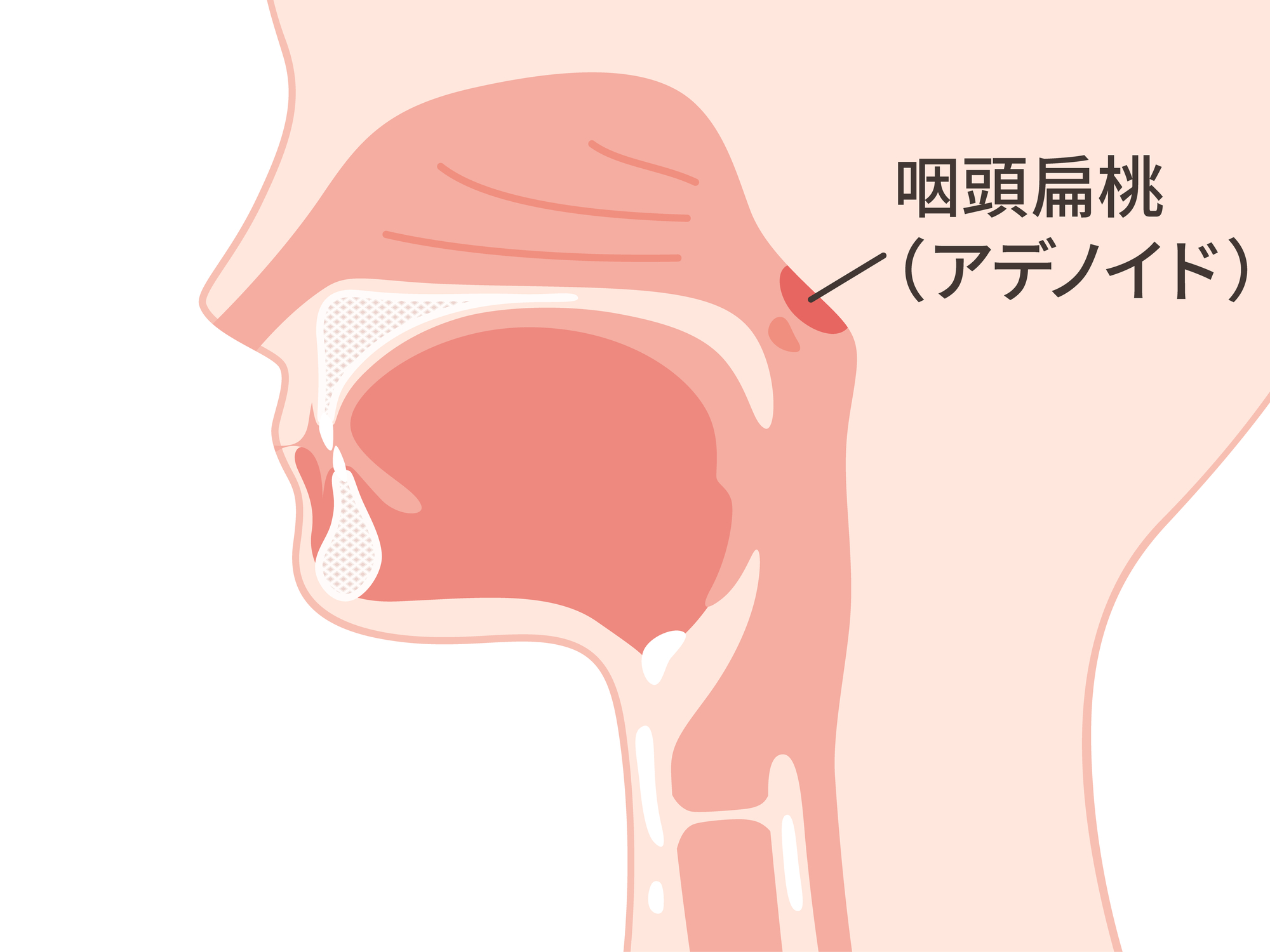 アデノイド肥大のイメージ│咽頭扁桃（アデノイド）